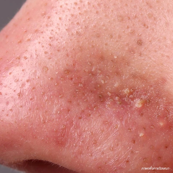 สิวอุดตันหัวขาว (Whiteheads)
