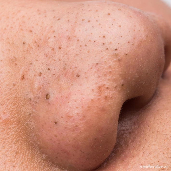 สิวอุดตันหัวดำ (Blackheads)