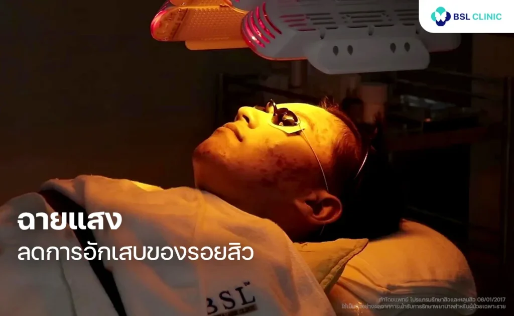 โปรแกรมฉายแสง เพื่อลดการอักเสบของสิว
