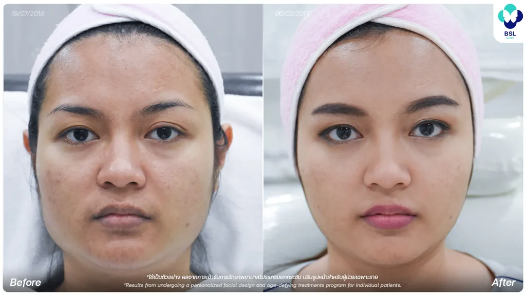 รีวิวยกกระชับหน้าไม่ผ่าตัดจากผู้รับบริการจริงที่ BSL Clinic