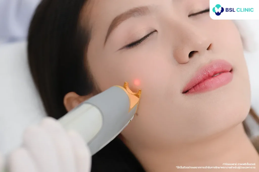 โปรแกรม DL laser เลเซอร์ลดรอยสิวที่ BSL clinic