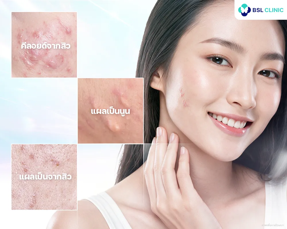 คีลอยด์จากสิว