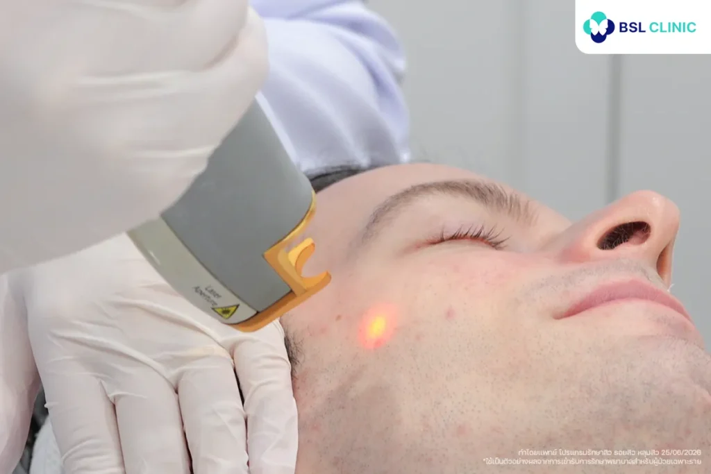 Laser Genesis เลเซอร์ลดรอยสิวที่ BSL clinic