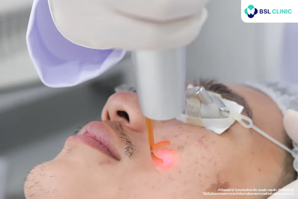 โปรแกรม PicoWay Laser
