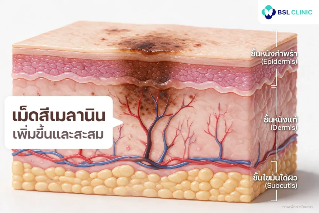รอยดำ (PIH)
