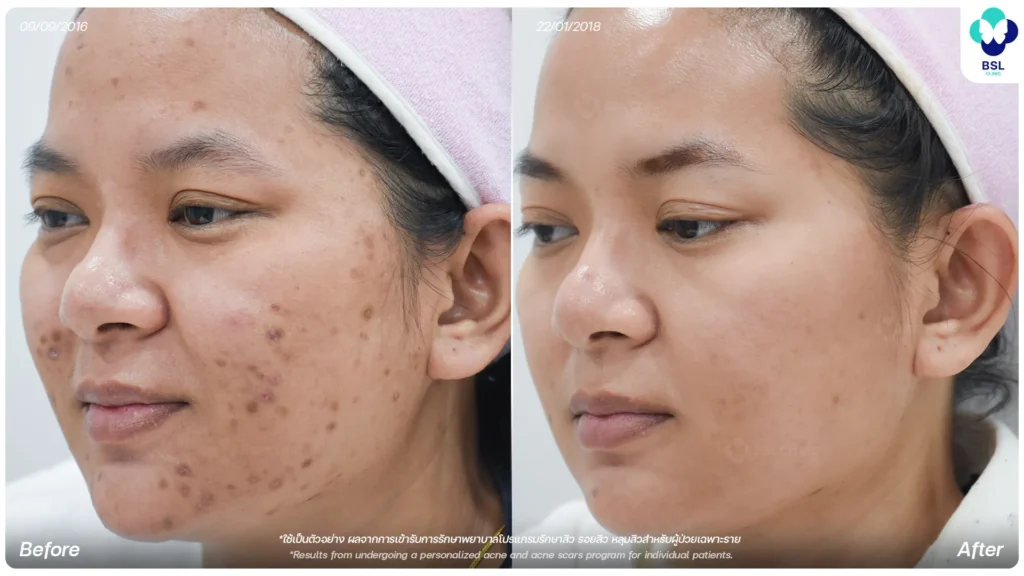 รีวิวรักษารอยสิว