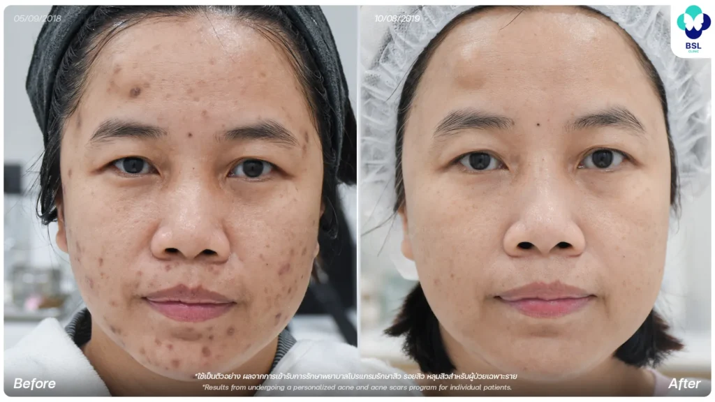 รีวิวรักษารอยสิว