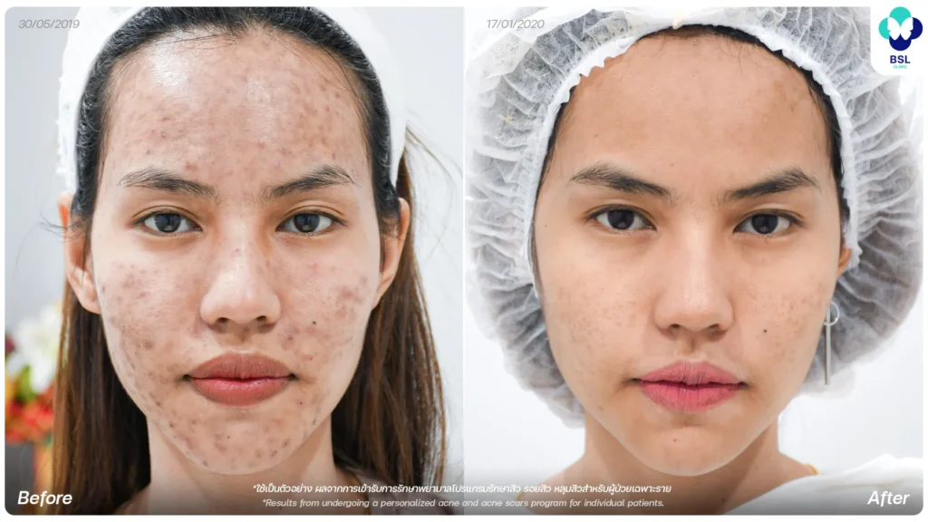 รีวิวรักษารอยสิว