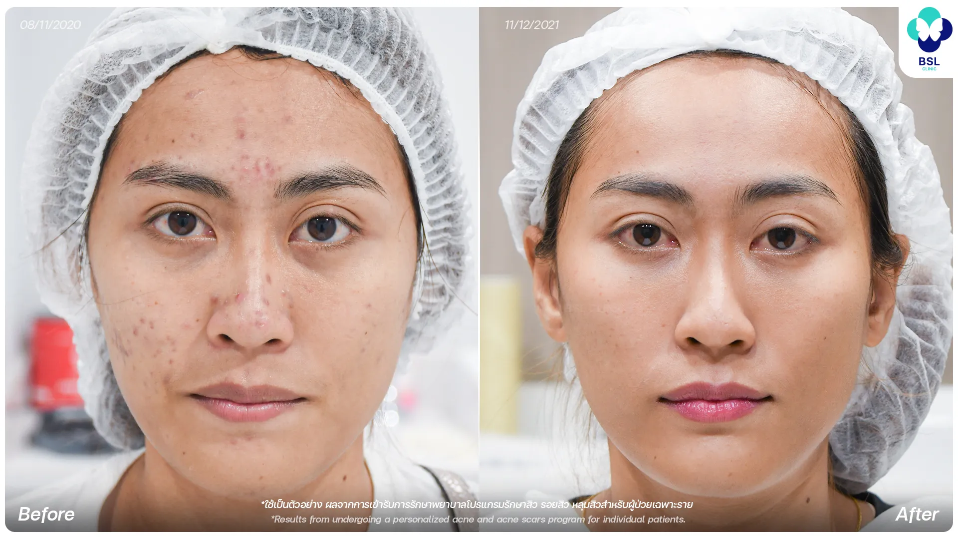 รีวิวรักษารอยสิว