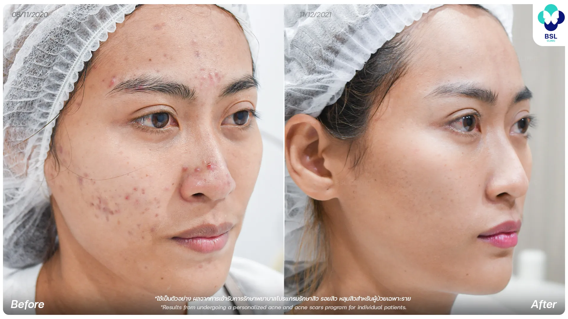 รีวิวรักษารอยสิว