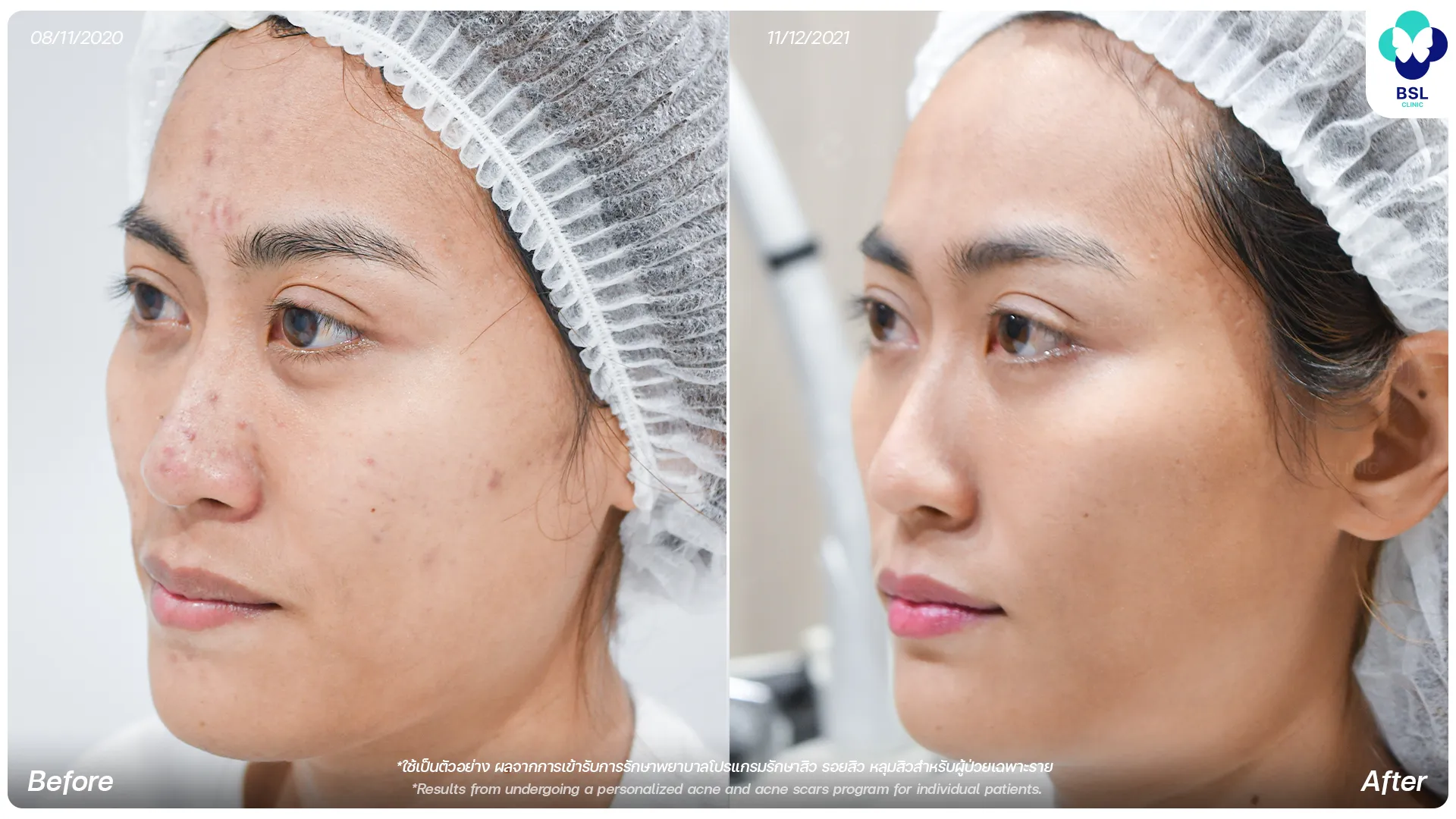รีวิวรักษารอยสิว
