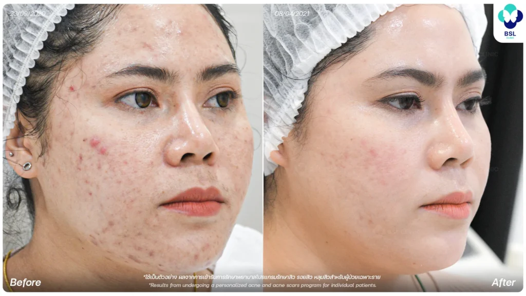 รีวิวรักษารอยสิว