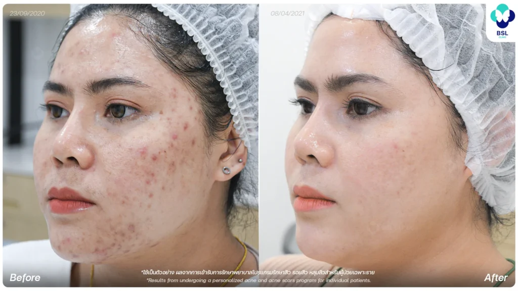 รีวิวรักษารอยสิว