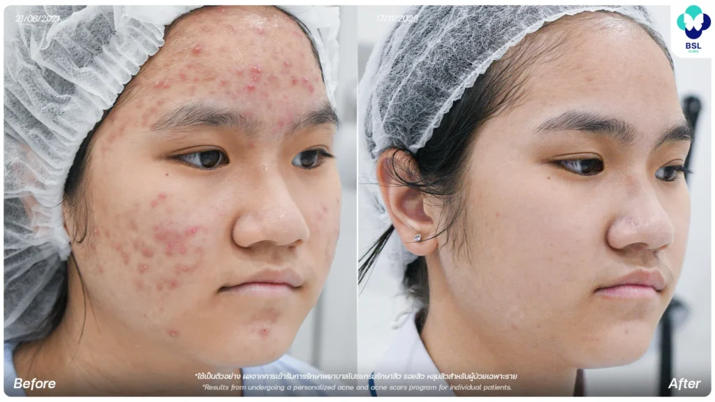 รีวิวรักษารอยสิว