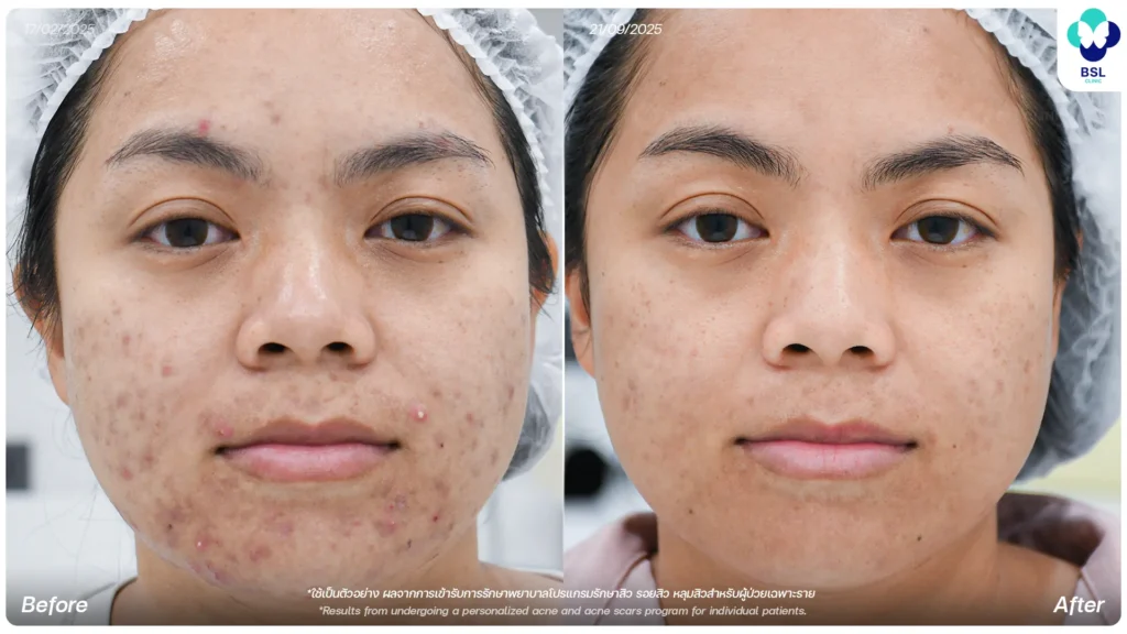 รีวิวรักษารอยสิว