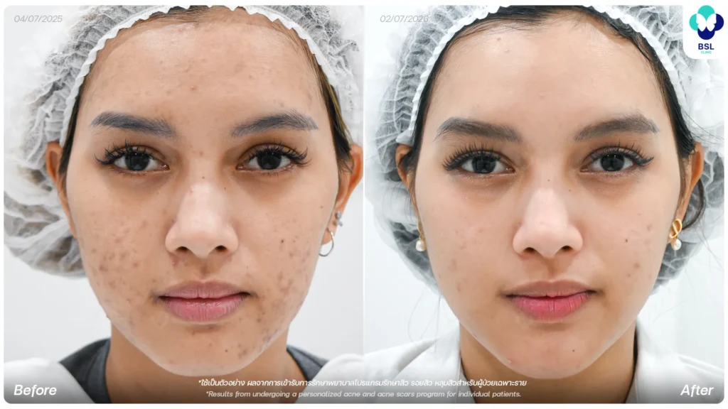 รีวิวรักษารอยสิว