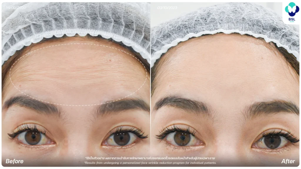 รีวิว ผลการรักษา ลดริ้วรอย ที่ BSL Clinic