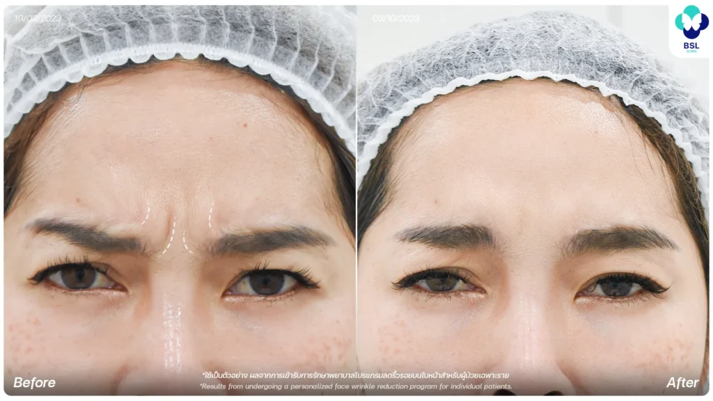รีวิว ผลการรักษา ลดริ้วรอย ที่ BSL Clinic