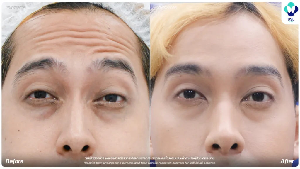 รีวิว ผลการรักษา ลดริ้วรอย ที่ BSL Clinic