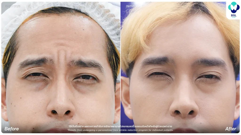 รีวิว ผลการรักษา ลดริ้วรอย ที่ BSL Clinic