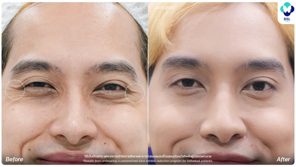 รีวิว ผลการรักษา ลดริ้วรอย ที่ BSL Clinic