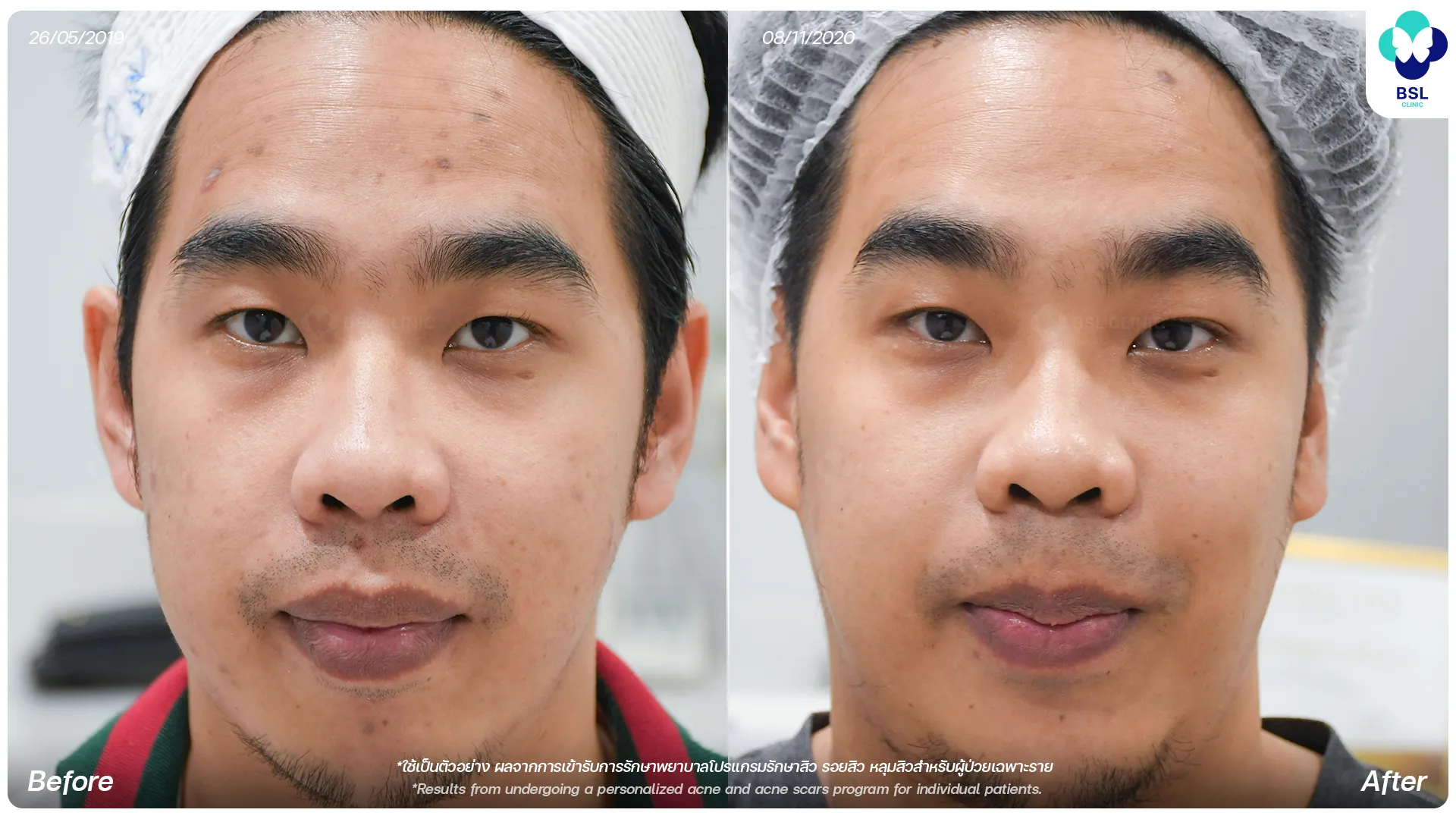 รีวิวรักษารอยสิว