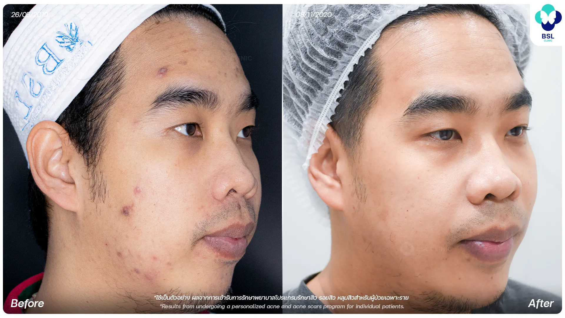 รีวิวรักษารอยสิว