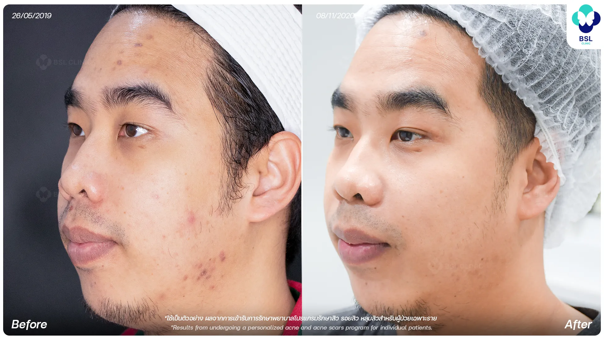 รีวิวรักษารอยสิว